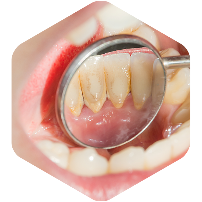 Teeth with discoloration
